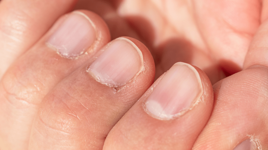 Eine Hand mit trockener Nagelhaut.