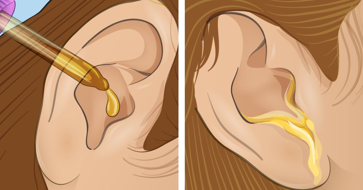 Verstopftes Ohr mit Öl reinigen.