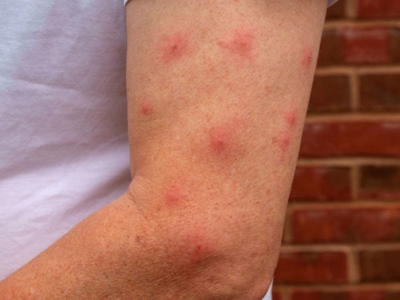 Viele Mückenstiche am Arm.