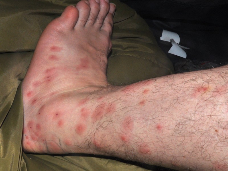 Ein Bein voller Mückenstiche.
