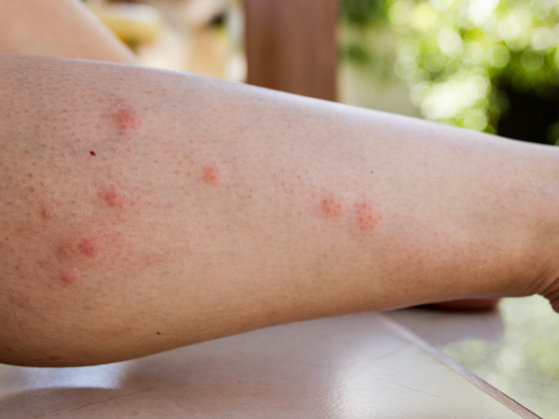 Von Mücken zerstochenes Bein