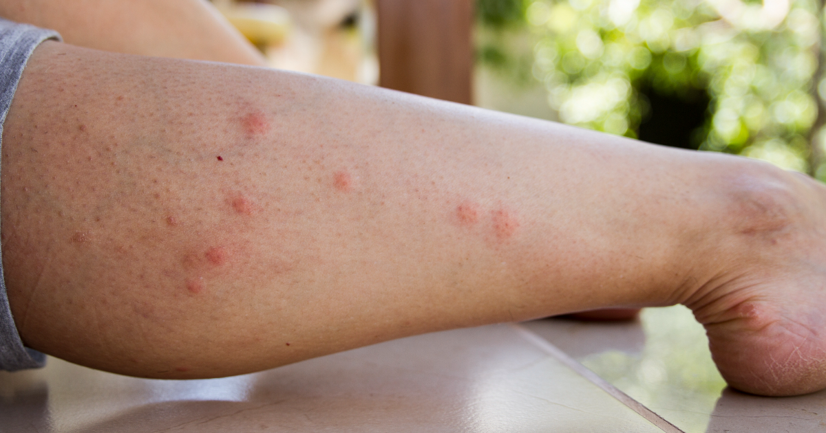 Von Mücken zerstochenes Bein