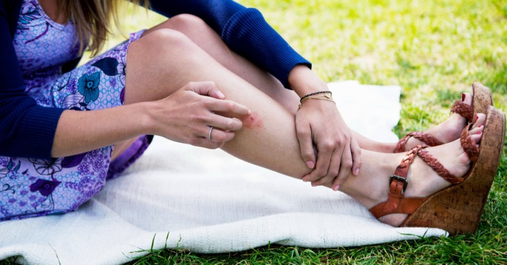 Frau kratzt Mückenstich am Bein auf