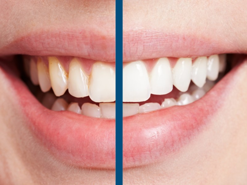 Vergleich von Zähnen vor und nach dem Bleichen beim Zahnarzt.