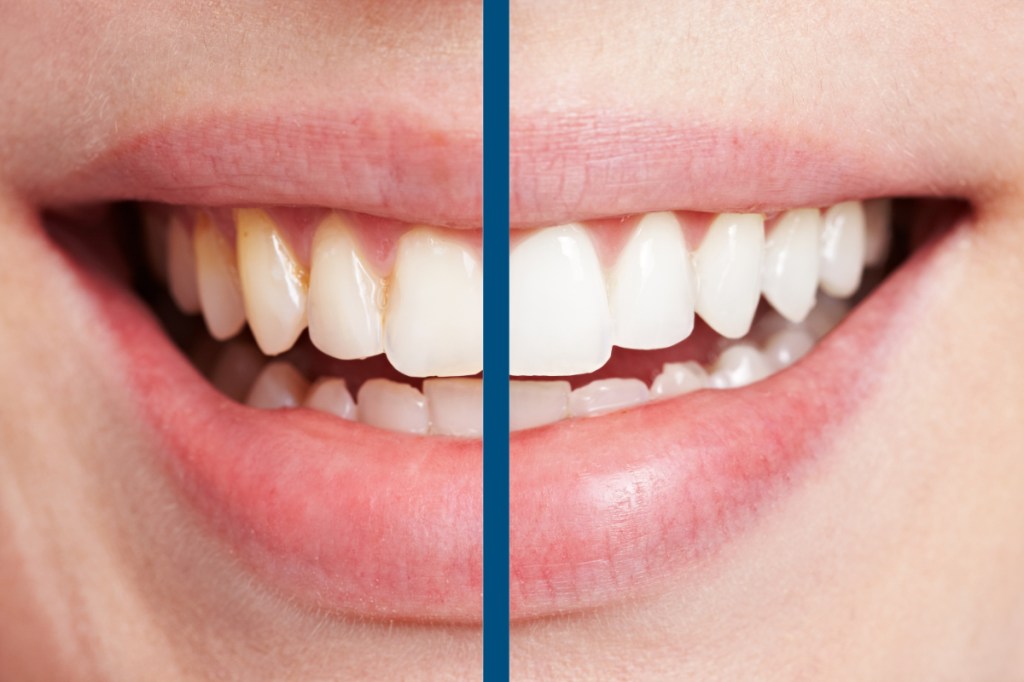 Vergleich von Zähnen vor und nach dem Bleichen beim Zahnarzt.