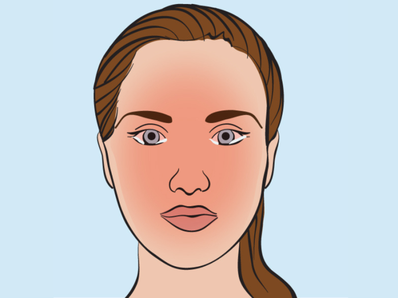 Die Illustration einer braunhaarigen Frau mit Sonnenbrand im Gesicht.