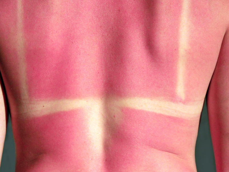 Rücken einer Frau mit sehr starkem Sonnenbrand.