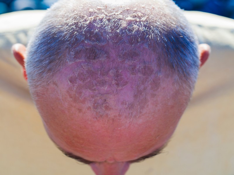 Mann mit starkem Sonnenbrand auf der Kopfhaut.