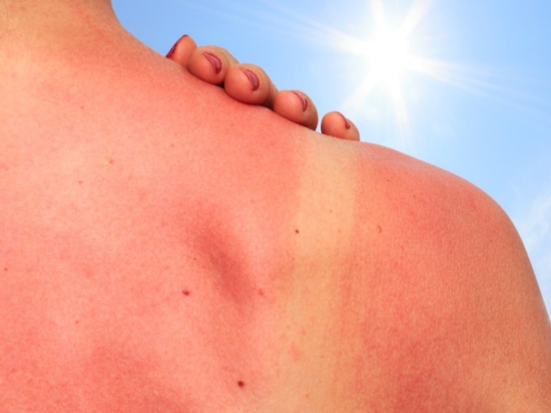 Der Rücken einer Frau mit einem deutlichen Sonnenbrand