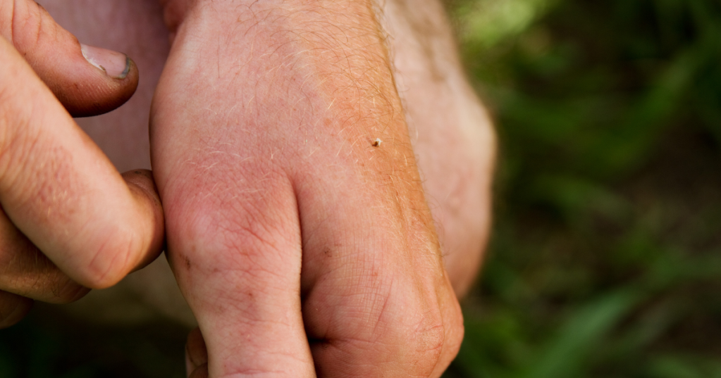 Eine Hand, in der ein Stechel von einer Biene oder Wespe sticht.