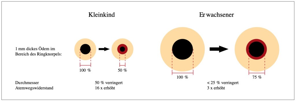 Grafik mit Luftröhrenödem bei Kindern und Erwachsenen